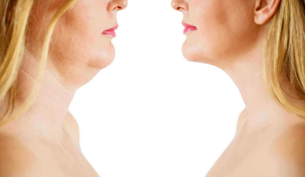 Double Chin treatment Greater London (Barking and Dagenham) before and after results