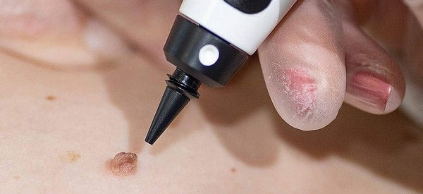 After Skin Tag Removal Greater London (Barking and Dagenham)