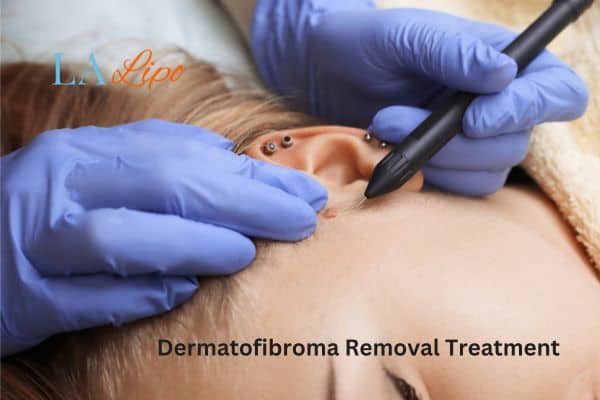 Dermatofibroma Removal Treatment Greater London (Barking and Dagenham)