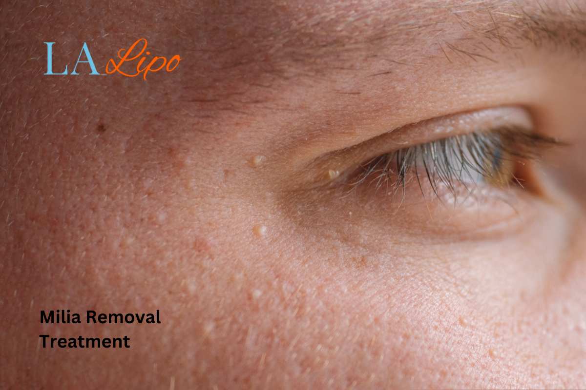 Cryopen Milia Removal: Is It the Easiest and Safest Option Greater London (Barking and Dagenham)?