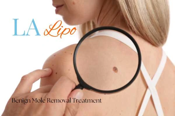 Woman having her inspection of blemish before mole removal Greater London (Barking and Dagenham)