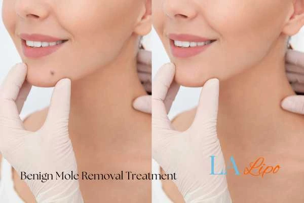 Before and after mole removal Greater London (Barking and Dagenham) treatment