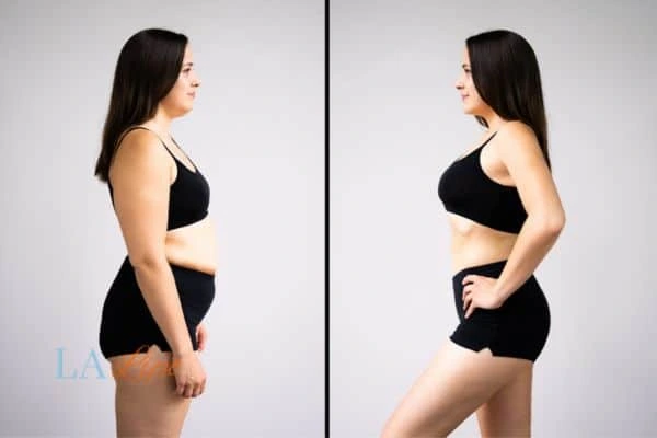 image of woman before and after results of LA-EMS Body Sculpting Greater London (Barking and Dagenham) to help treat Diastasis recti