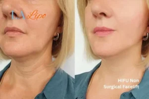 hi-fu for wrinkles Greater London (Barking and Dagenham) before and after results