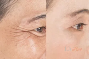 Before and after results of woman - HI-fu wrinkles reduction treatment Greater London (Barking and Dagenham)