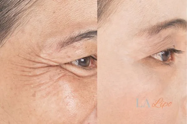 Before and after results of woman - HI-fu wrinkles reduction treatment Greater London (Barking and Dagenham)