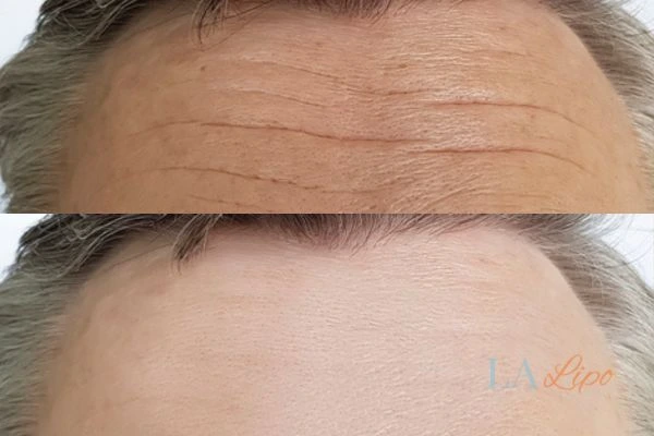 results of HIFU Greater London (Barking and Dagenham) on mans forehead to help reduce lines and wrinkles