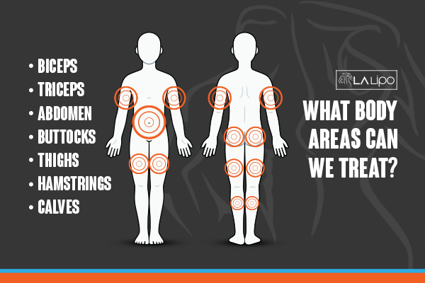 Graphic to show areas you can have LA-EMS Body Sculpting Greater London (Barking and Dagenham) treatment.