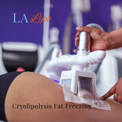 fat freezing - Cryolipolysis Greater London (Barking and Dagenham)