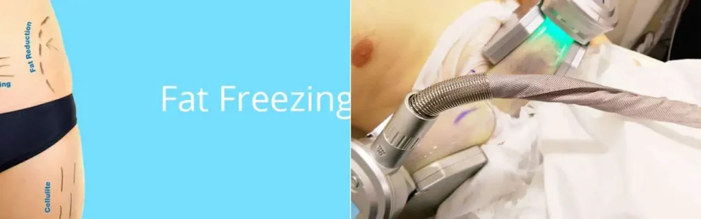 multi areas of a persons body having coolsculpting Greater London (Barking and Dagenham) treatment