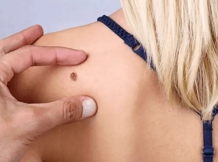 woman having mole removal Greater London (Barking and Dagenham) consultation before treatment.