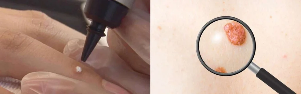 Person getting moles removed with cryopen Greater London (Barking and Dagenham)