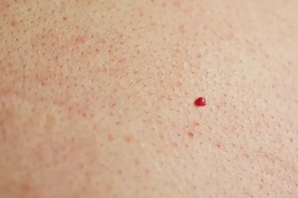 close up of a cherry angioma Greater London (Barking and Dagenham)