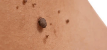 image of a skin tag Greater London (Barking and Dagenham)