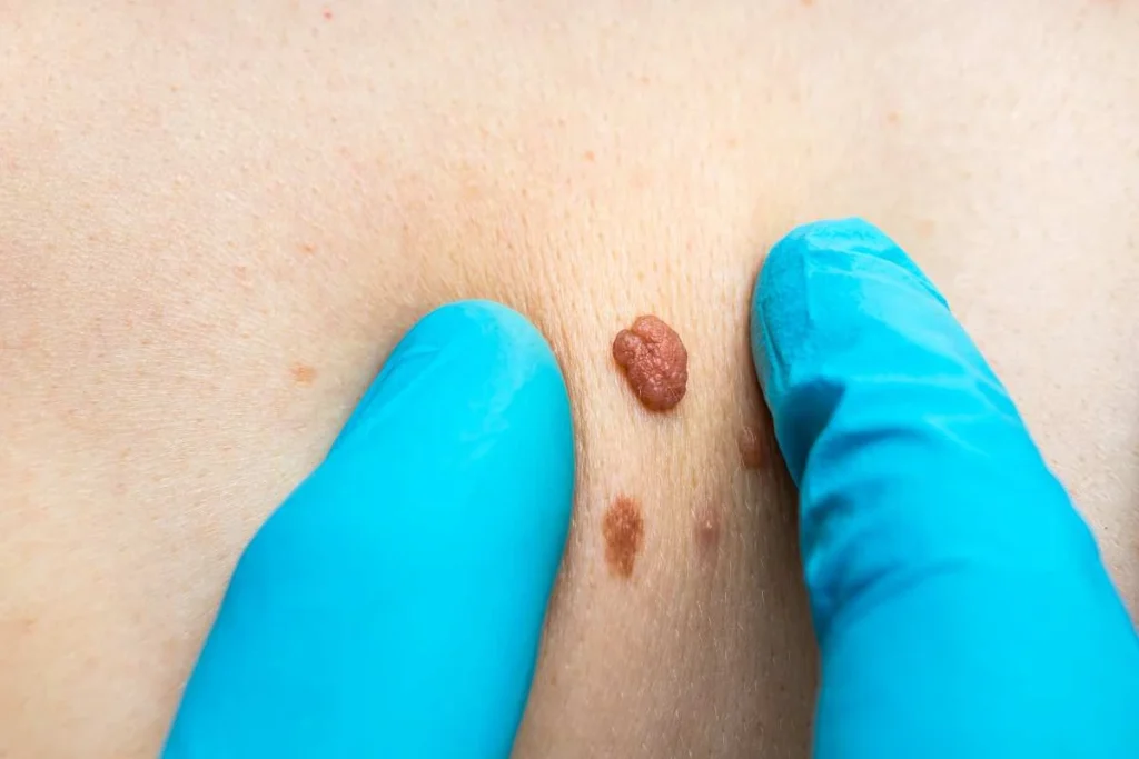 Consultant examining a skin tag Greater London (Barking and Dagenham)