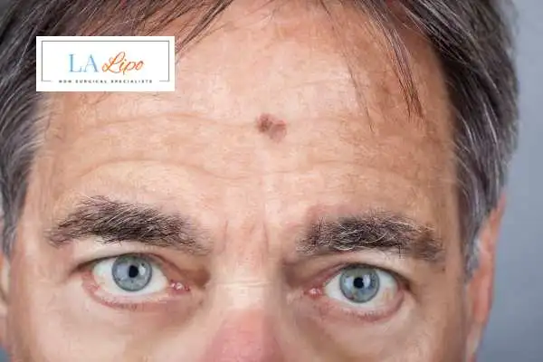 Solar Lentigo Removal Greater London (Barking and Dagenham) image of man with mark on his forehead
