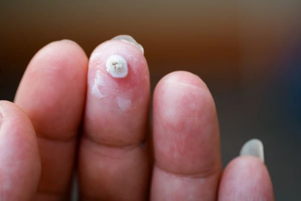 wart on person finger - cryotherapy to treat from LA LIPO Greater London (Barking and Dagenham)