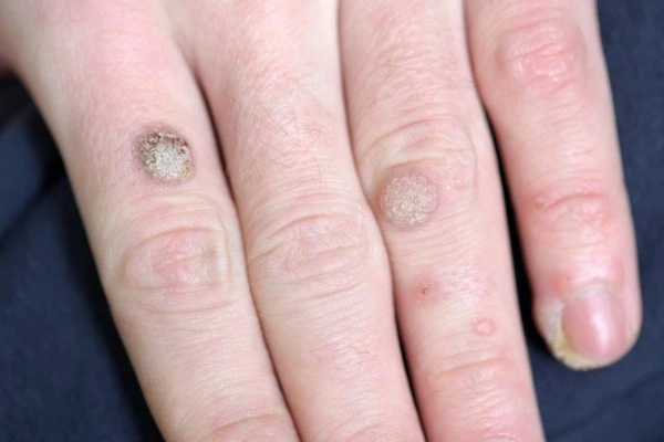 photo of warts on person hand - see wart removal Greater London (Barking and Dagenham) from LA LIPO