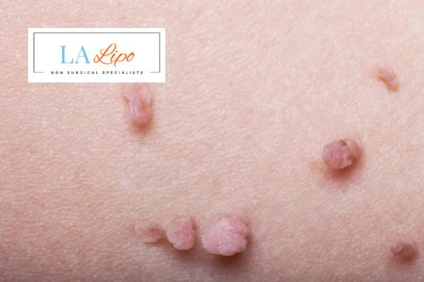 Does cryopen skin tag removal Greater London (Barking and Dagenham) hurt? Find out now call our team today!
