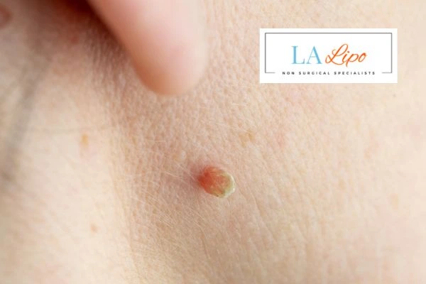 Book skin tag removal Greater London (Barking and Dagenham) today speak to our team now!