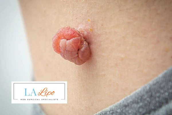 Interested in skin tag removal Greater London (Barking and Dagenham)? Concerned about the pain? Find out more today!