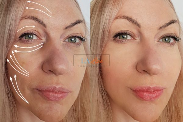 Morpheus 8 results Greater London (Barking and Dagenham) face lift.