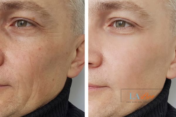 See the amazing results of Morpheus8 Treatment Greater London (Barking and Dagenham)!