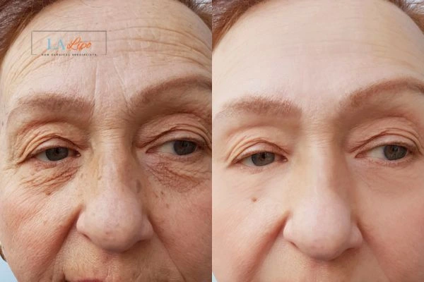 The powerful benefits of Morpheus8 Treatment Greater London (Barking and Dagenham) - Call Our team today!