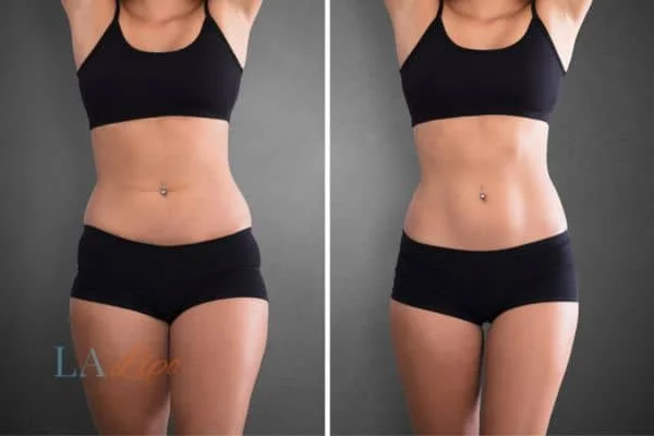 before and after results of non-surgical treatment to help a woman's body image and mental health Greater London (Barking and Dagenham)