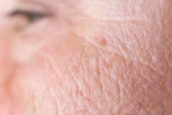 close up picture of a woman's face showing an age spot Greater London (Barking and Dagenham)