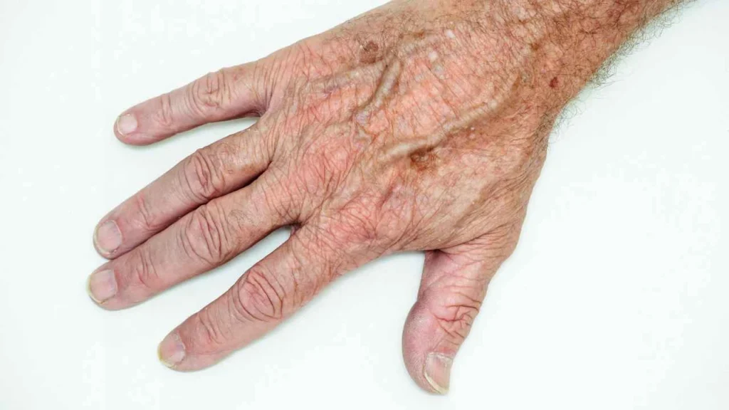 Male hand showing age spot Greater London (Barking and Dagenham)