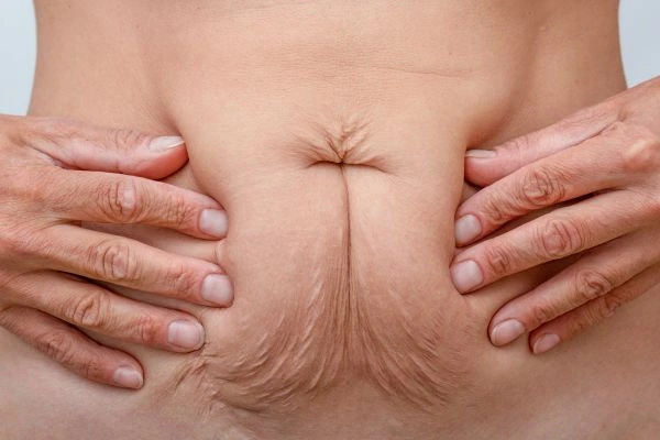 Image of a woman's stomach with loose skin - example of skin tightening Greater London (Barking and Dagenham) options