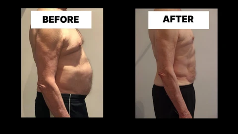 What Symptoms Can Diastasis Recti Cause in Men? Weak Core, Back Pain and Poor Posture Greater London (Barking and Dagenham)
